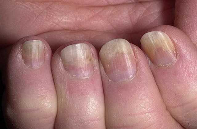 Расскажем, как восстановить ногти после гель лака