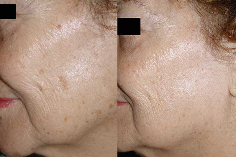 Топ-5 способов, как выровнять цвет кожи на лице