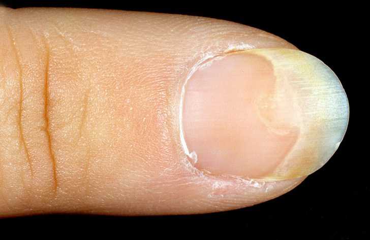 Последствия после покрытия ногтей гель-лаком Использование аптечных препаратов для регенерации поврежденных пластин Альтернатива: бюджетные народные рецепты для возвращения блеска и твердости ногтям