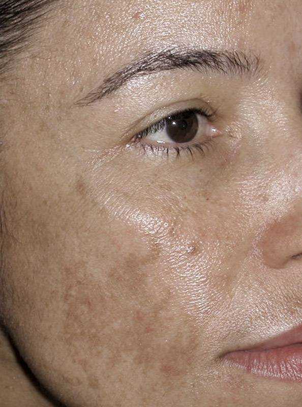 Как выровнять тон кожи лица косметикой