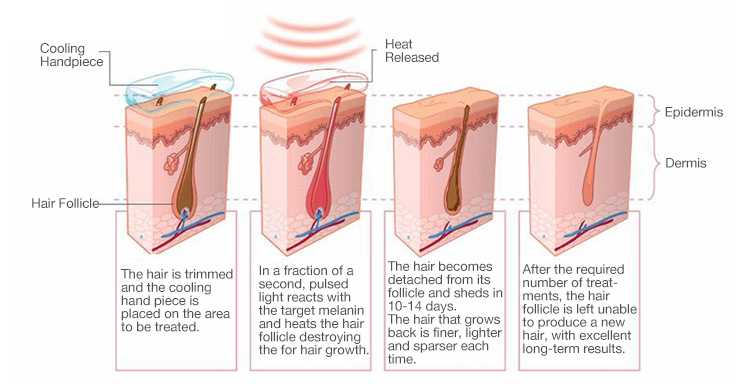 Домашний лазерный эпилятор позволяет быстро удалить нежелательные волосы с любых зон на теле Его использование безболезненно и дает долговременные результаты