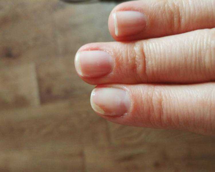 Почему болят ногти после гель лака — 5 причин и решение.