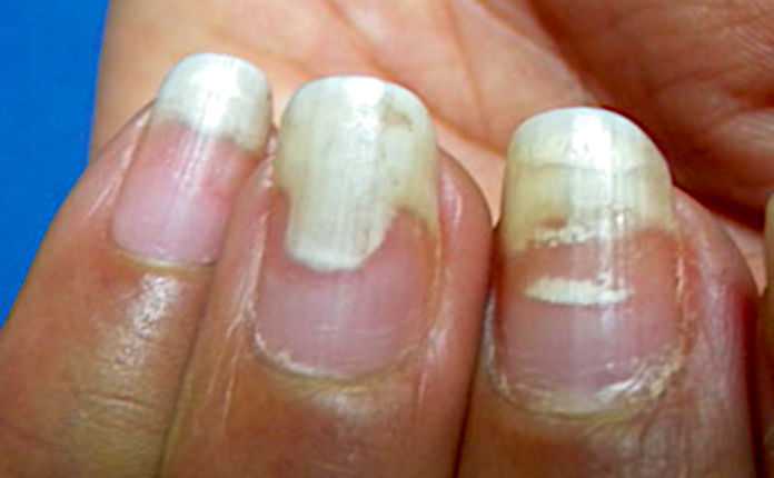 Восстановление ногтей после гель лака — это не работает