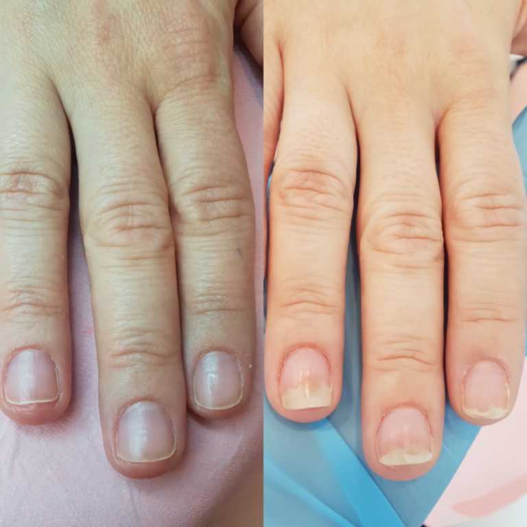 Как восстановить ногти после шеллака – лечение ногтей после гель-лака
