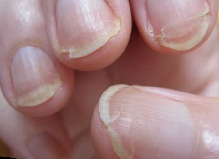 Как быстро восстановить ногти после гель-лака
