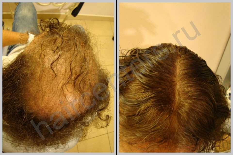 Филлеры для восстановления волос