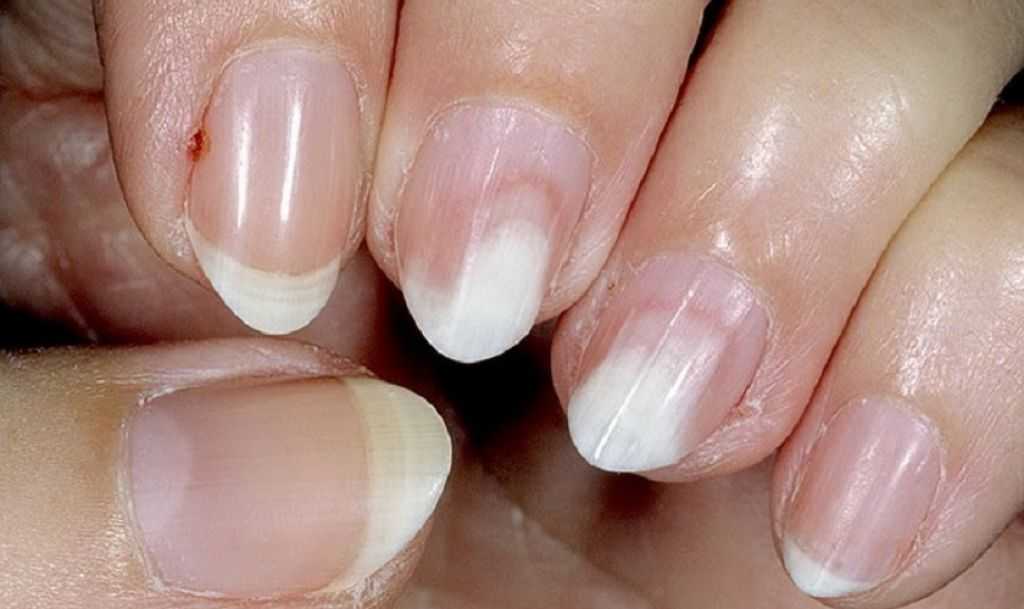 Как восстановить ногти после шеллака и гель-лака: лечение, укрепление, профилактика в домашних условиях