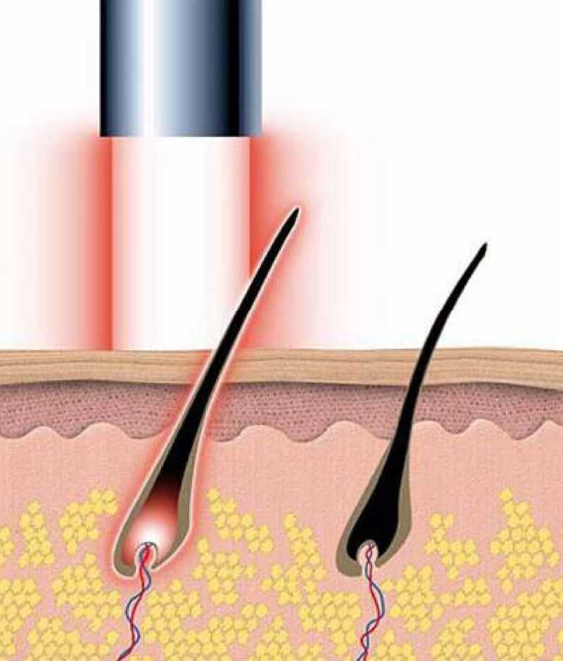 Александритовый лазер — эффективный способ удаления нежелательных волос