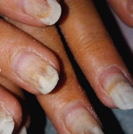 Как восстановить ногти после шеллака: самые эффективные пути решения проблемы