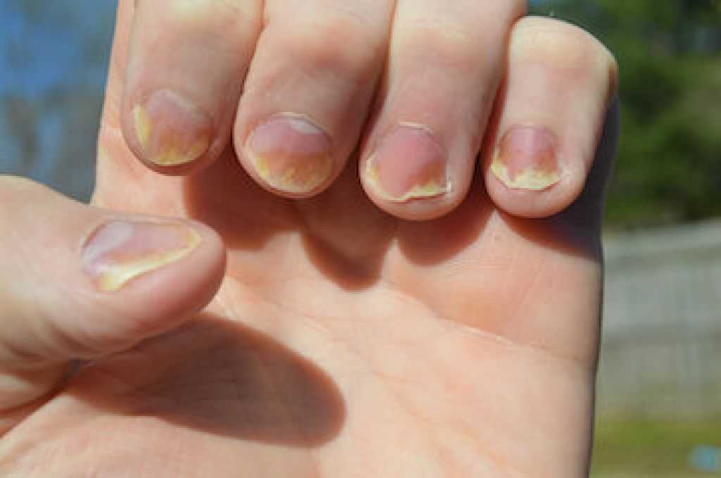 Как восстановить ногти после шеллака в домашних условиях: список восстанавливающих лаков
