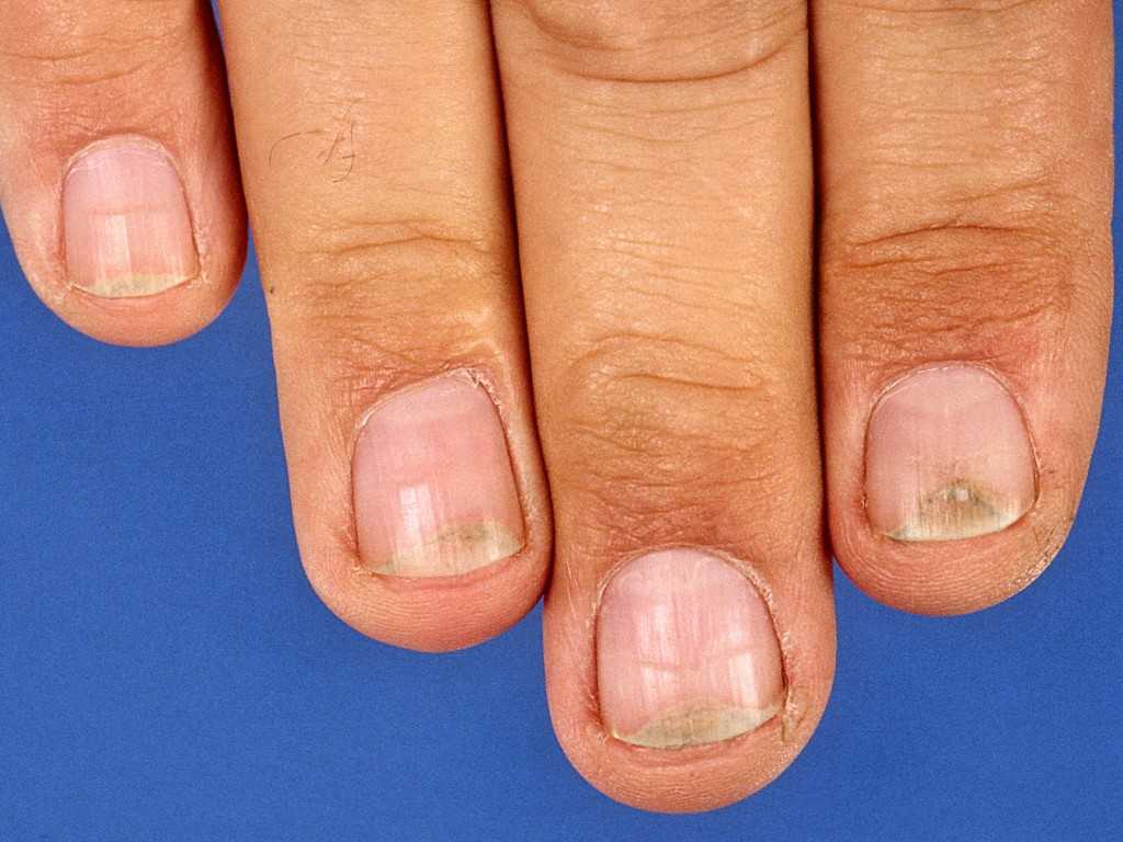 5 причин почему болят ногти после гель лака