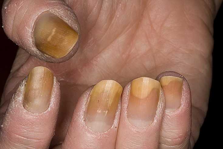 Как восстановить ногти после гель лака: пошаговое описание как восстановить ногтевую пластину (90 фото и видео)